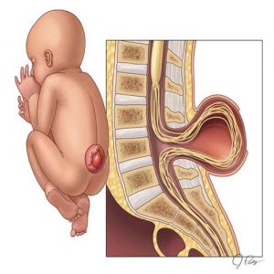 کمبود اسید فولیک و اسپینابیفیدا
