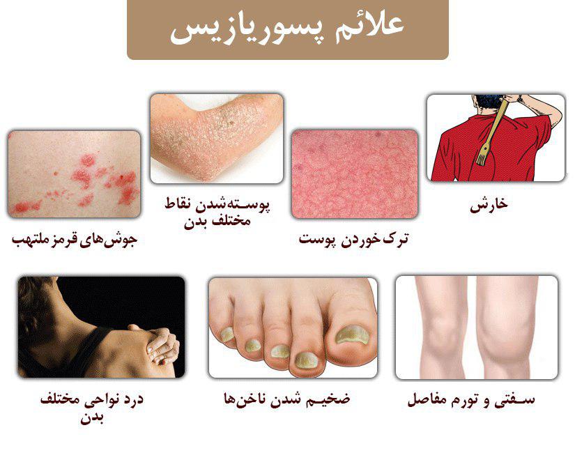 پسوریازیس چیست؟