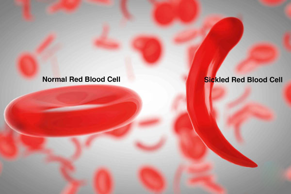 sickled_cell_01.jpg