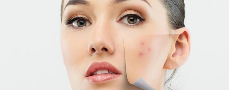 برطرف کردن جوش های فصلی و علل آن 