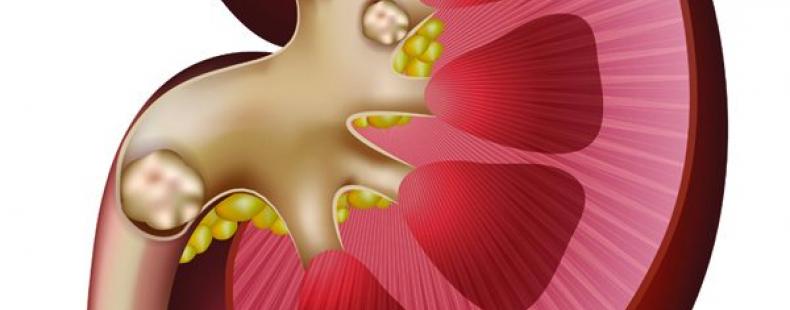 راهکارهای مقابله با سنگ کلیه