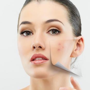 برطرف کردن جوش های فصلی و علل آن 