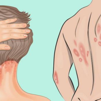 علائم بیماری پسوریازیس چیست؟