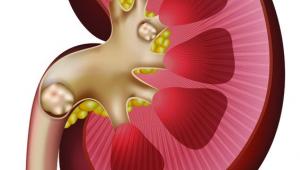 راهکارهای مقابله با سنگ کلیه