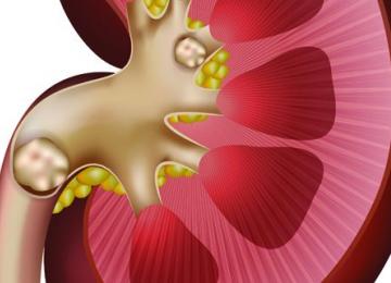 راهکارهای مقابله با سنگ کلیه